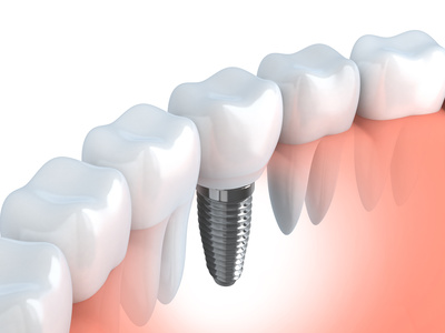 Zahnersatz durch Implantat